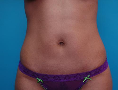 Mini Tummy Tuck Before and After Pictures Fort Lauderdale, FL