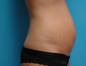 Mini Tummy Tuck Before and After Pictures Fort Lauderdale, FL