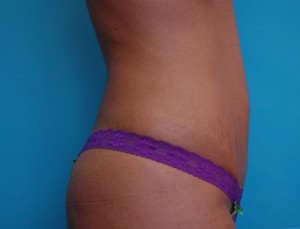 Mini Tummy Tuck Before and After Pictures Fort Lauderdale, FL