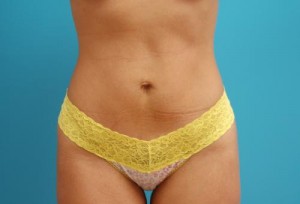 Mini Tummy Tuck Before and After Pictures Fort Lauderdale, FL