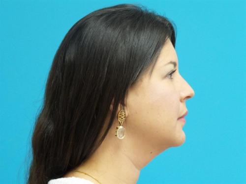 Neck Liposuction Before and After Pictures Fort Lauderdale, FL