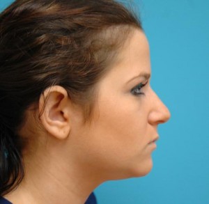 Neck Liposuction Before and After Pictures Fort Lauderdale, FL