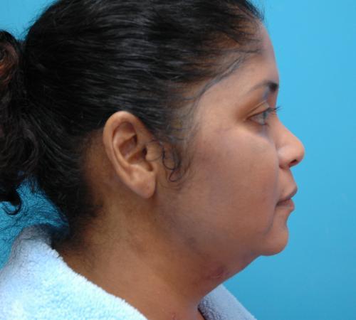 Neck Liposuction Before and After Pictures Fort Lauderdale, FL