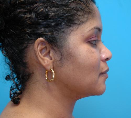 Neck Liposuction Before and After Pictures Fort Lauderdale, FL