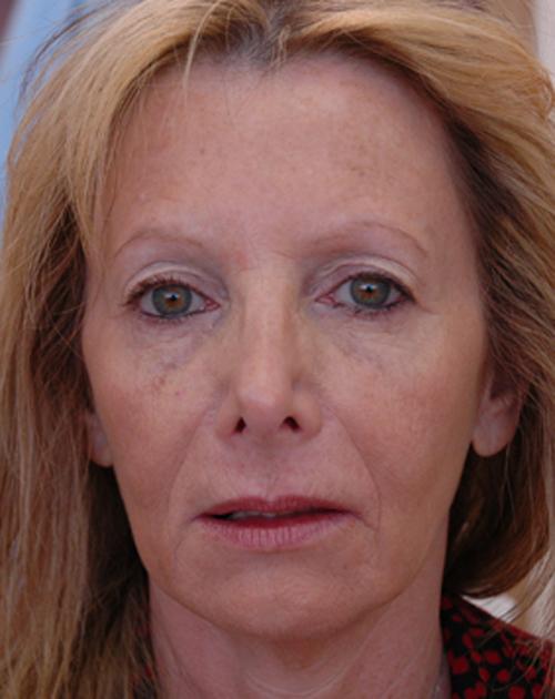 Radiesse-02 Fillers Before and After Pictures Fort Lauderdale, FL