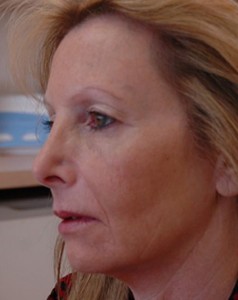 Fillers Before and After Pictures Fort Lauderdale, FL