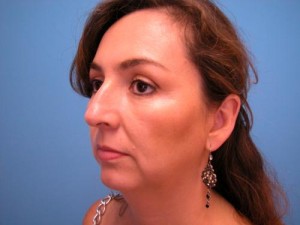 Rhinoplasty Before and After Pictures Fort Lauderdale, FL