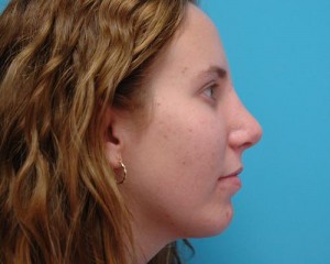 Rhinoplasty Before and After Pictures Fort Lauderdale, FL