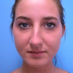 Rhinoplasty Before and After Pictures Fort Lauderdale, FL
