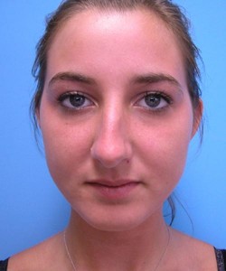 Rhinoplasty Before and After Pictures Fort Lauderdale, FL