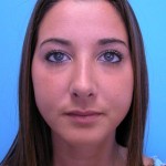 Rhinoplasty Before and After Pictures Fort Lauderdale, FL