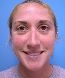 Rhinoplasty Before and After Pictures Fort Lauderdale, FL