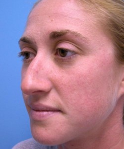 Rhinoplasty Before and After Pictures Fort Lauderdale, FL