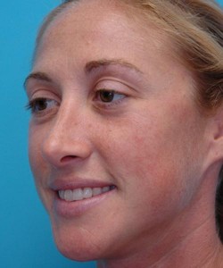 Rhinoplasty Before and After Pictures Fort Lauderdale, FL