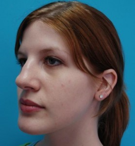 Rhinoplasty Before and After Pictures Fort Lauderdale, FL