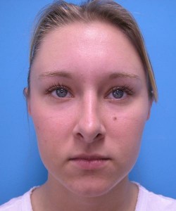 Rhinoplasty Before and After Pictures Fort Lauderdale, FL