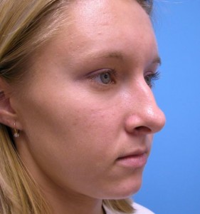 Rhinoplasty Before and After Pictures Fort Lauderdale, FL