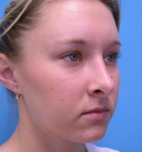 Rhinoplasty Before and After Pictures Fort Lauderdale, FL