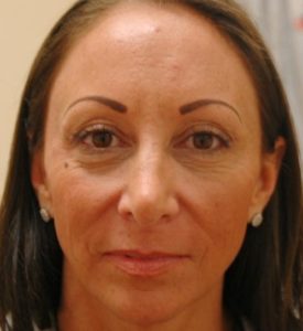 Sculptra Before and After Pictures Fort Lauderdale, FL