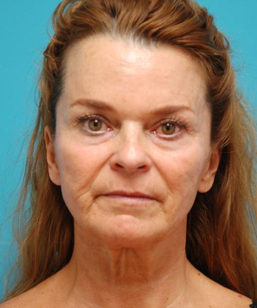 Sculptra Before and After Pictures Fort Lauderdale, FL