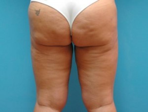 Thigh Lift Before and After Pictures Fort Lauderdale, FL