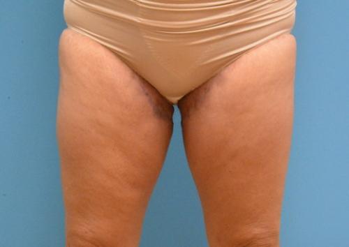 Thigh Lift Before and After Pictures Fort Lauderdale, FL