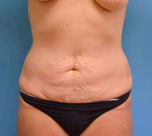 Tummy Tuck Before and After Pictures Fort Lauderdale, FL