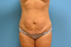 Tummy Tuck Before and After Pictures Fort Lauderdale, FL