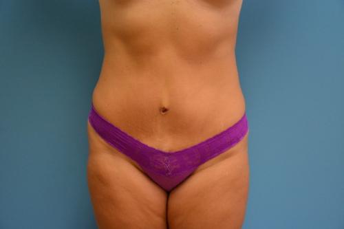 Tummy Tuck Before and After Pictures Fort Lauderdale, FL