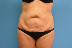 Tummy Tuck Before and After Pictures Fort Lauderdale, FL