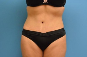 Tummy Tuck Before and After Pictures Fort Lauderdale, FL