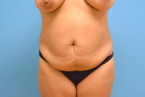 Tummy Tuck Before and After Pictures Fort Lauderdale, FL