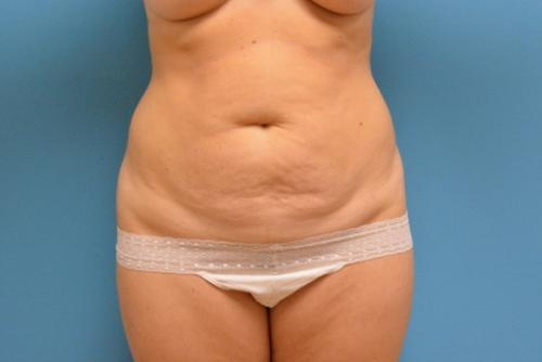 Tummy Tuck Before and After Pictures Fort Lauderdale, FL