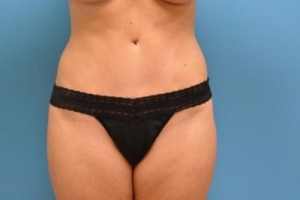 Tummy Tuck Before and After Pictures Fort Lauderdale, FL