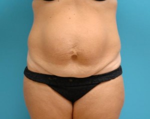 Tummy Tuck Before and After Pictures Fort Lauderdale, FL