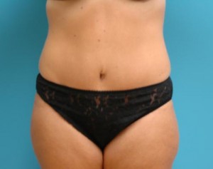 Tummy Tuck Before and After Pictures Fort Lauderdale, FL