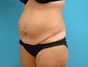 Tummy Tuck Before and After Pictures Fort Lauderdale, FL