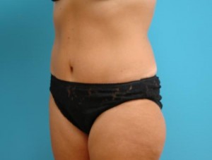 Tummy Tuck Before and After Pictures Fort Lauderdale, FL