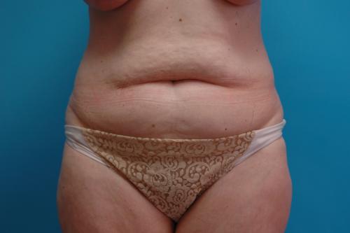 Tummy Tuck Before and After Pictures Fort Lauderdale, FL