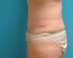 Tummy Tuck Before and After Pictures Fort Lauderdale, FL