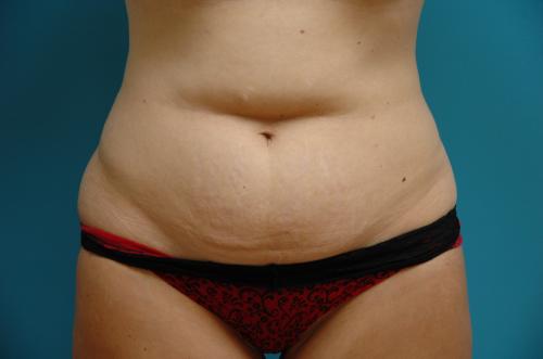 Tummy Tuck Before and After Pictures Fort Lauderdale, FL