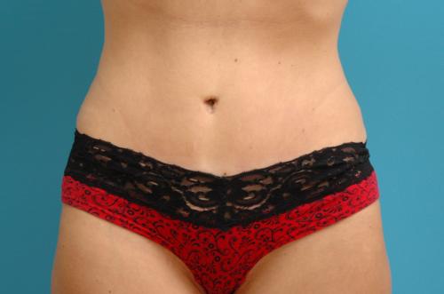 Tummy Tuck Before and After Pictures Fort Lauderdale, FL