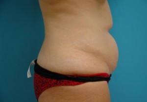 Tummy Tuck Before and After Pictures Fort Lauderdale, FL