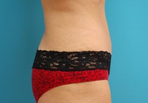 Tummy Tuck Before and After Pictures Fort Lauderdale, FL