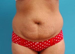 Tummy Tuck Before and After Pictures Fort Lauderdale, FL