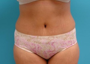 Tummy Tuck Before and After Pictures Fort Lauderdale, FL