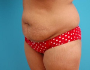 Tummy Tuck Before and After Pictures Fort Lauderdale, FL