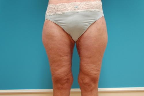 After Massive Weight Loss Before and After Pictures Fort Lauderdale, FL