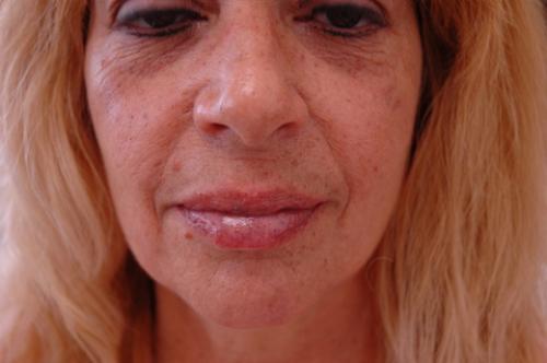 Lip Augmentation Before and After Pictures Fort Lauderdale, FL