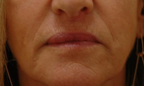 Lip Augmentation Before and After Pictures Fort Lauderdale, FL
